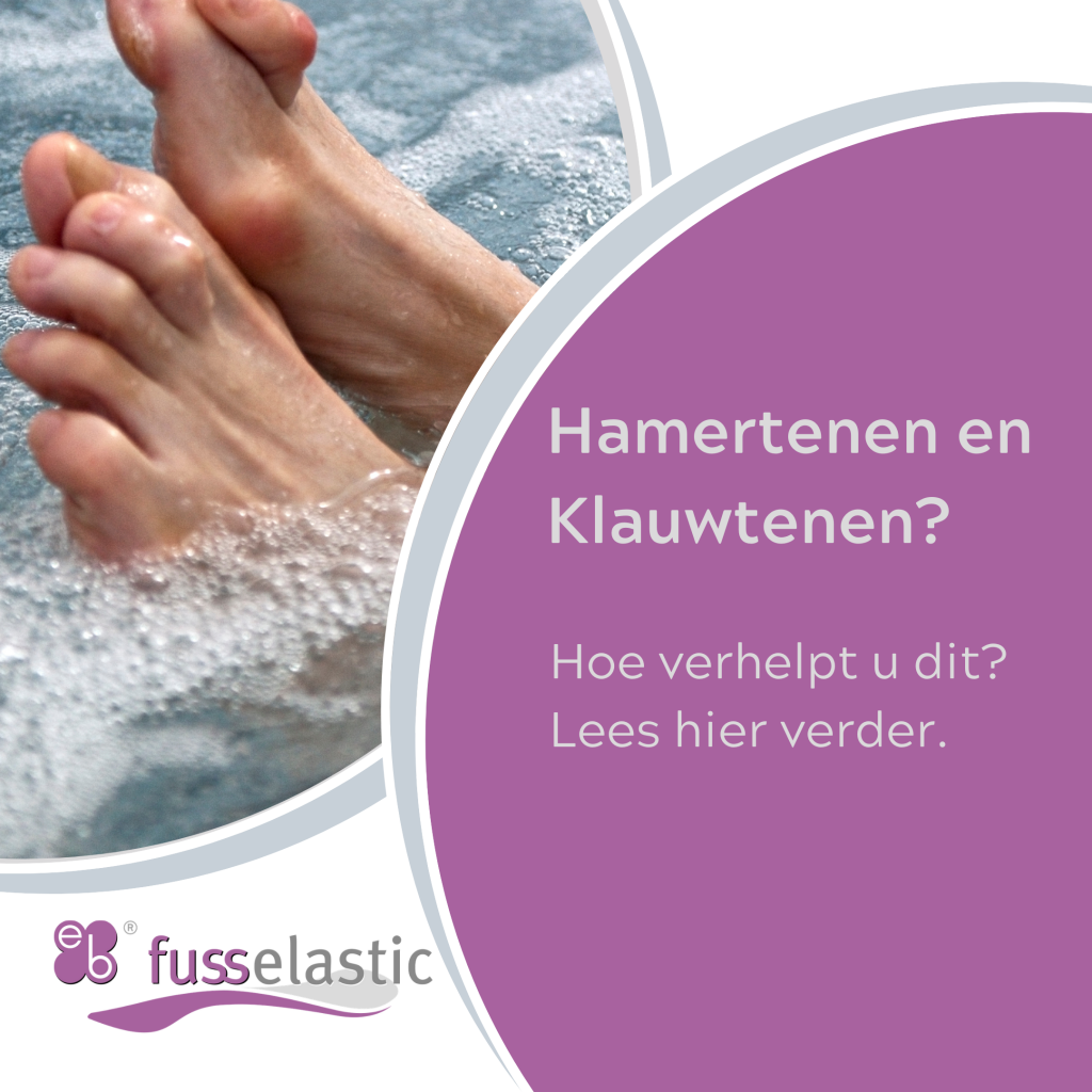 Pijnlijke en kromme tenen? Misschien heeft u last van hamertenen of  klauwtenen - Fusselastic steunzolen